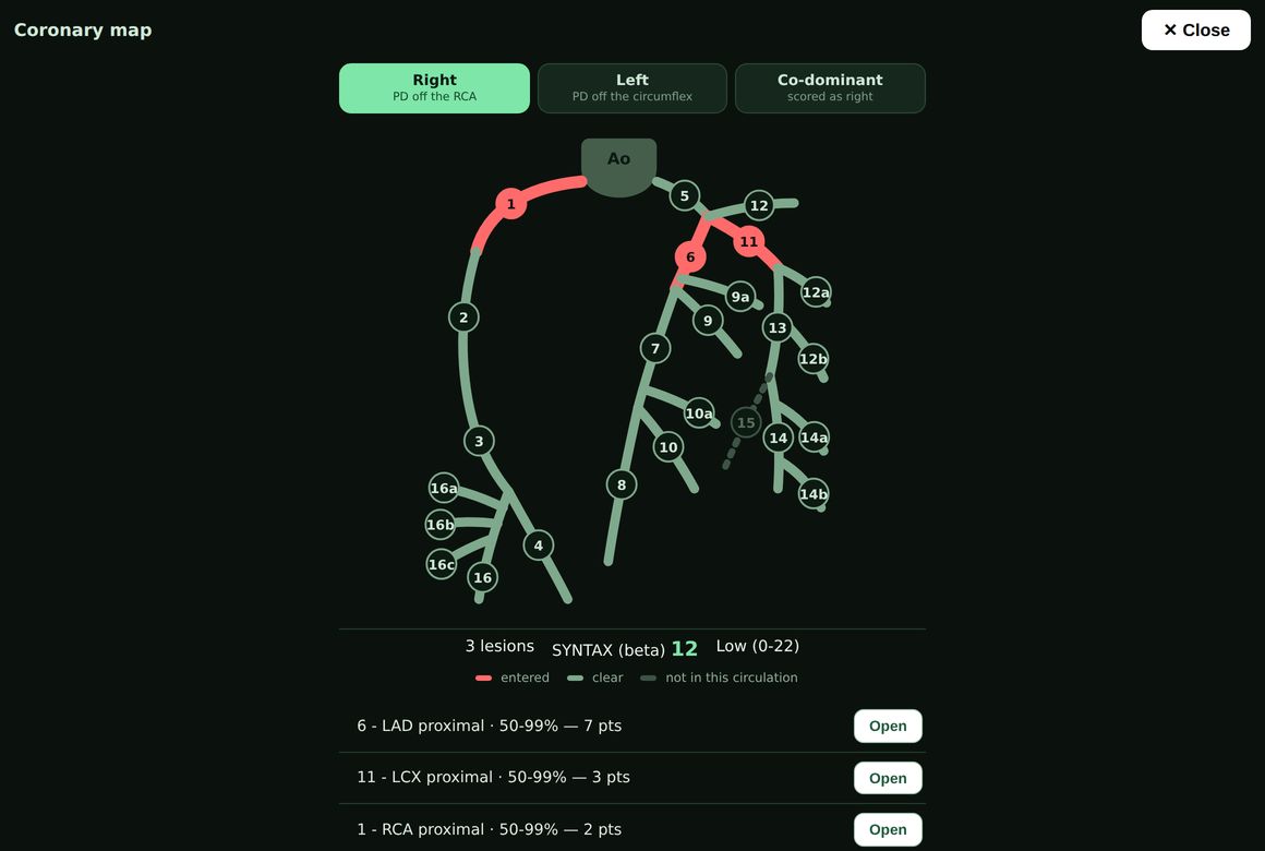 The coronary map: a 25-segment tree, right dominant, with entered lesions marked in red and the running SYNTAX total beneath it.